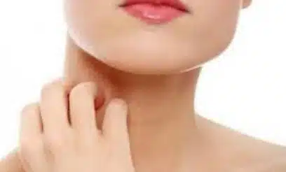 ketoconazolo crema